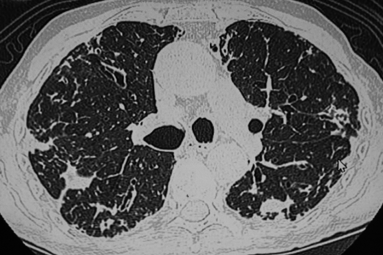 Scan - infection des poumons